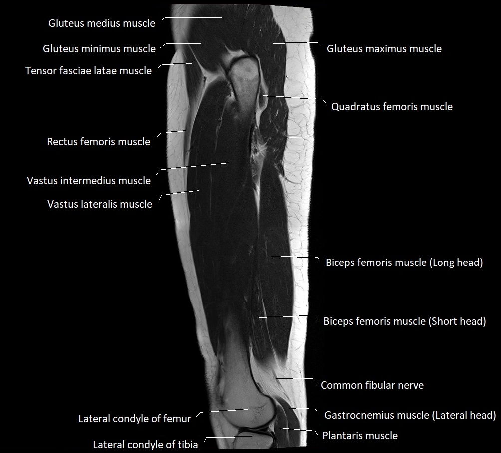 Thigh sagittal cross sectional anatomy MRI 3T image 6.webp